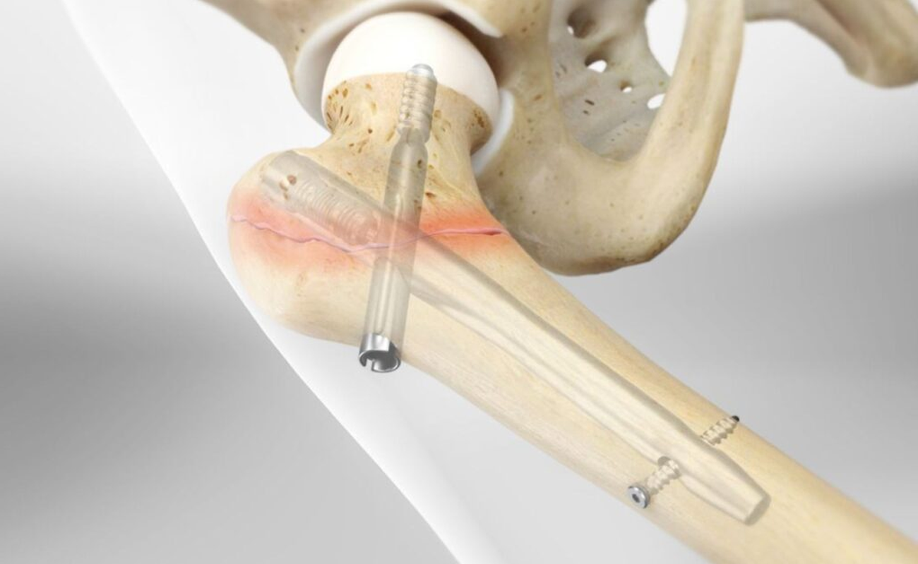 Bone Fracture Fixation