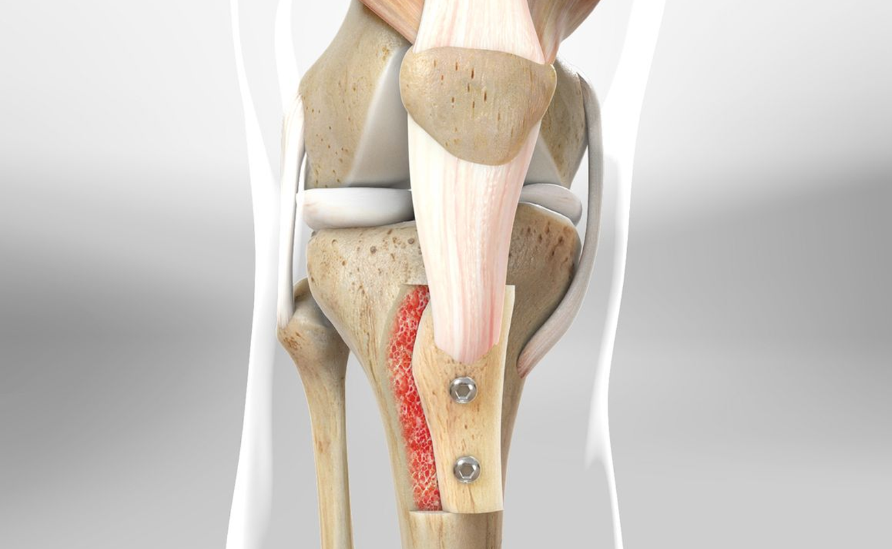 Knee Osteotomy