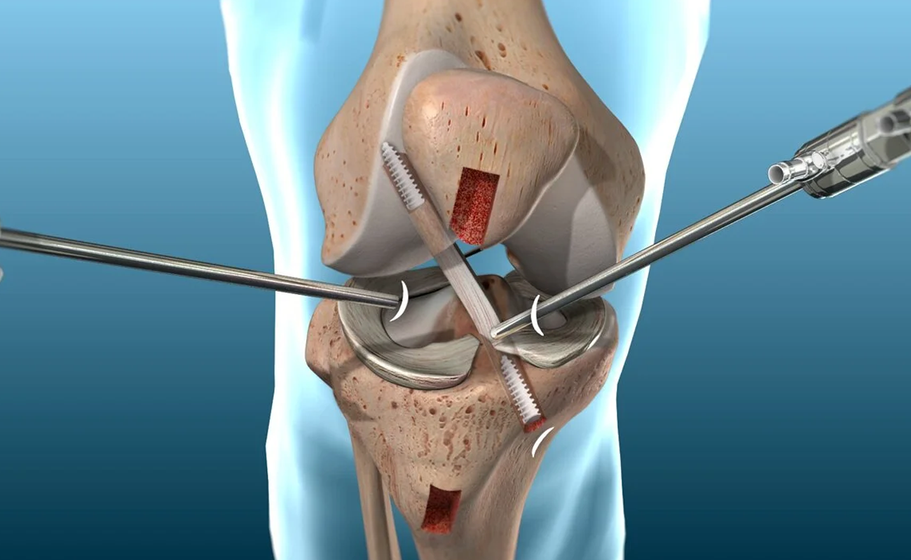 Ligament Repair