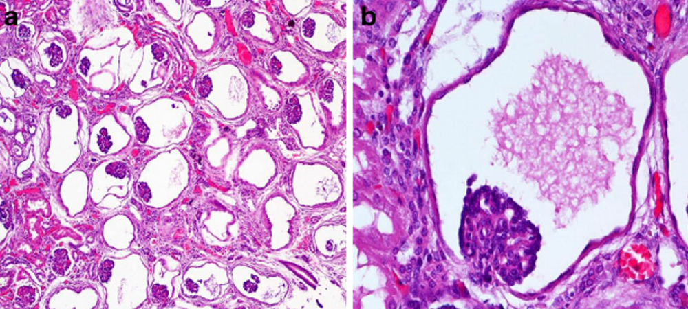 Glomerular and Cystic Kidney Diseases