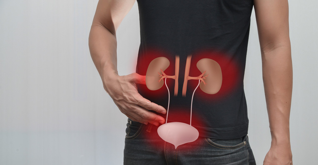 Understanding Renal Stones