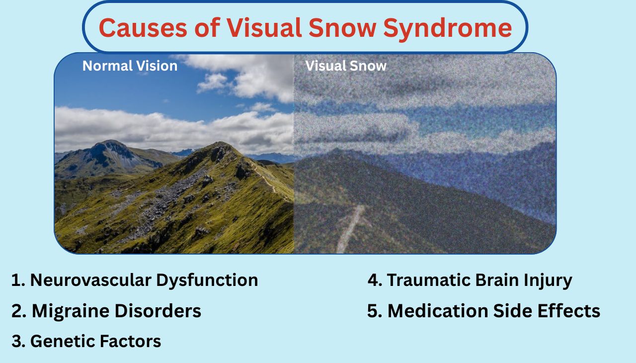 Causes of Visual Snow Syndrome