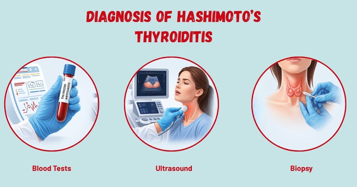 Diagnosis of Hashimoto’s Thyroiditis