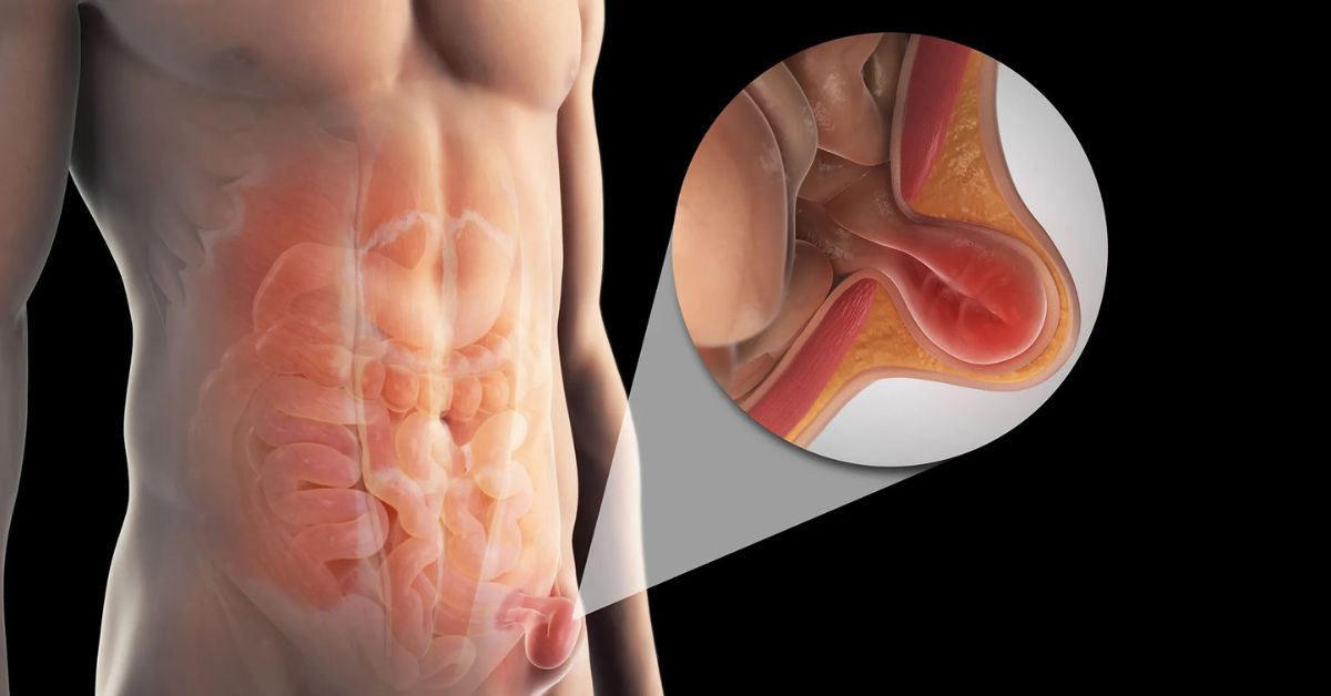 Factors That Affect The Cost of Hiatus Hernia Surgery?