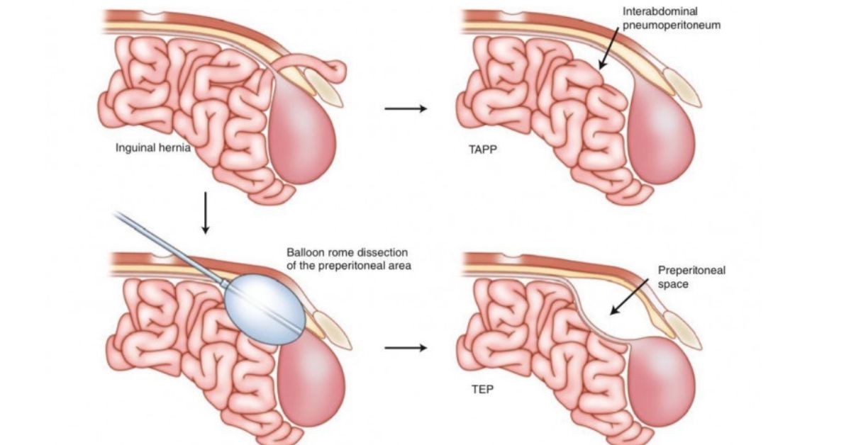 Hiatus Hernia Surgery Covered By Insurance