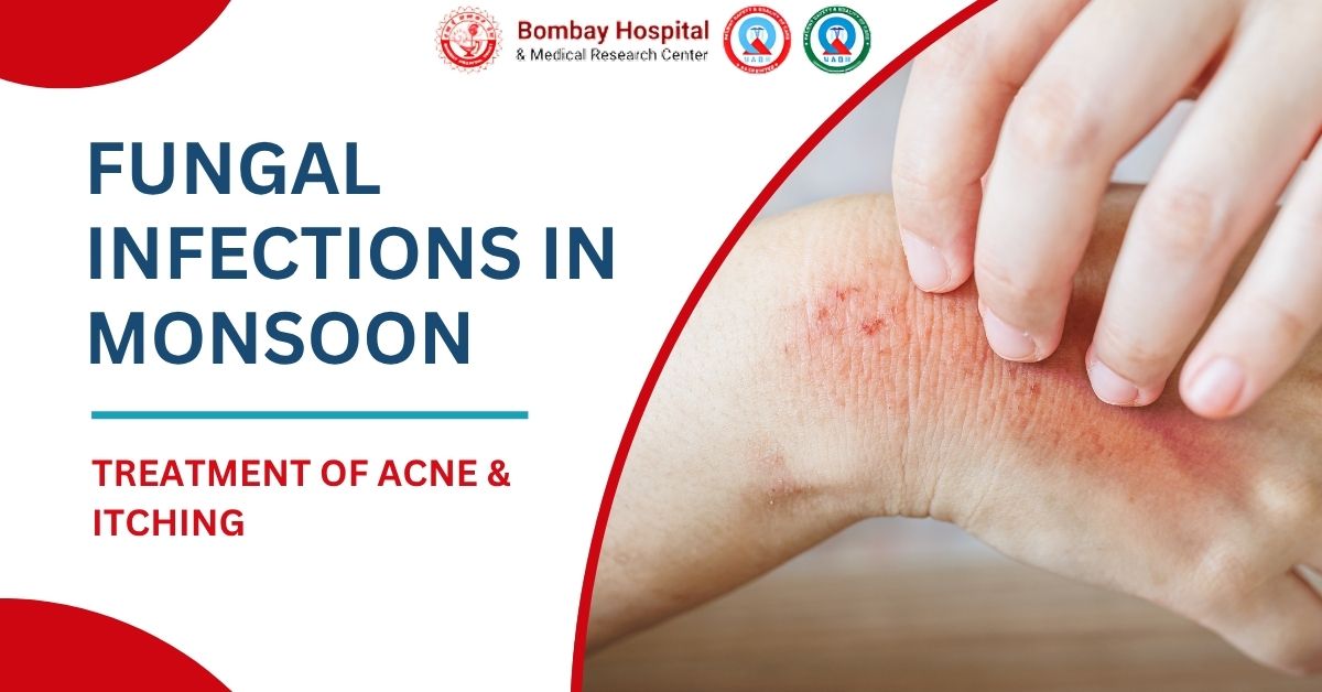 Get treatment of fungal infections in monsoon by dermatologist in Mumbai at bombay hospital