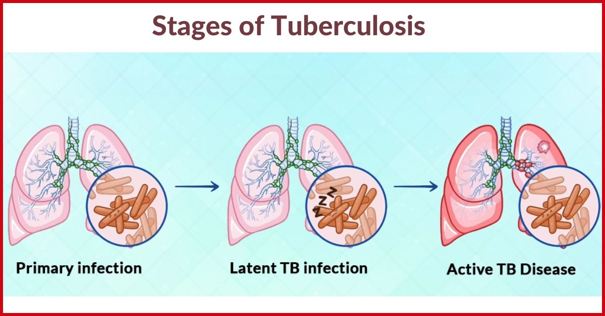 What Is Tuberculosis