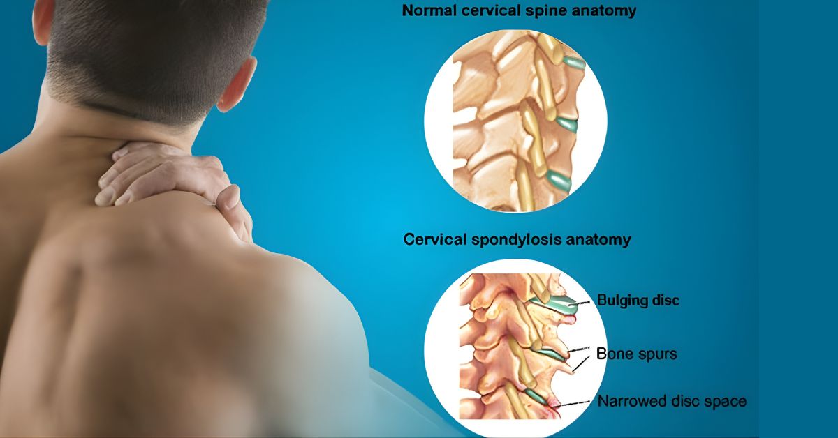 Treatment for cervical spondylosis in mumbai