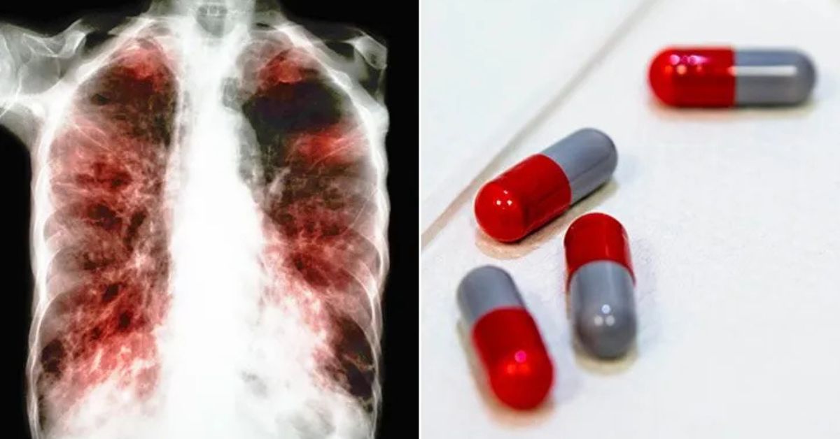 Treatment Options for Tuberculosis