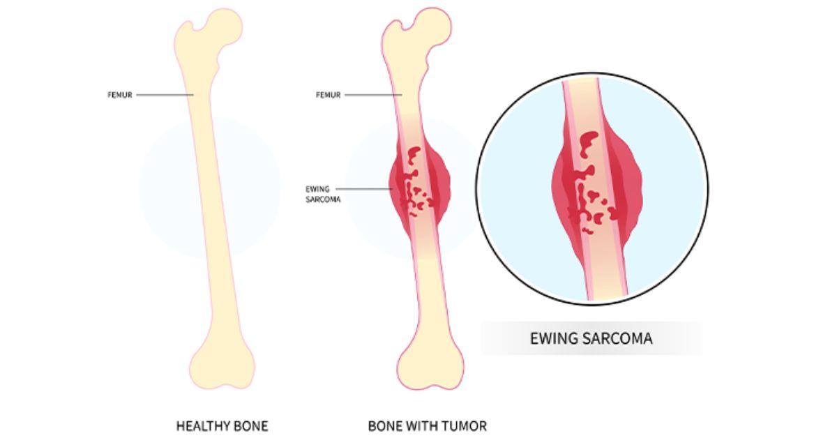 Understanding Bone Cancer and the Recovery Process