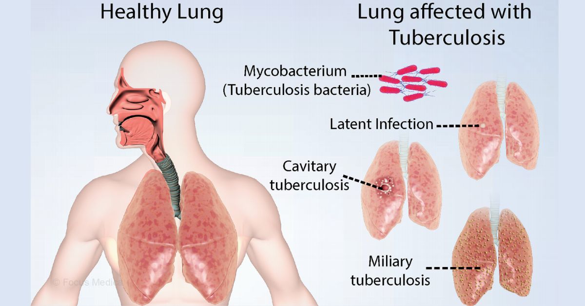 Understanding Tuberculosis