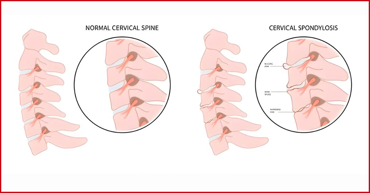 What Is Cervical Spondylosis?