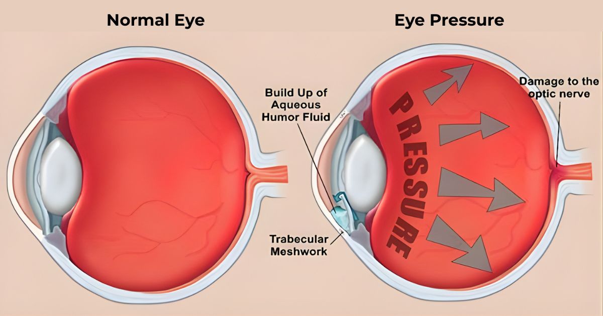 What Is Eye Pressure