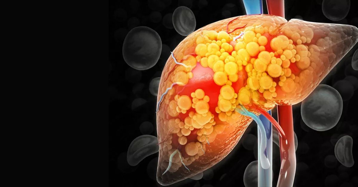 What is Fatty Liver issue