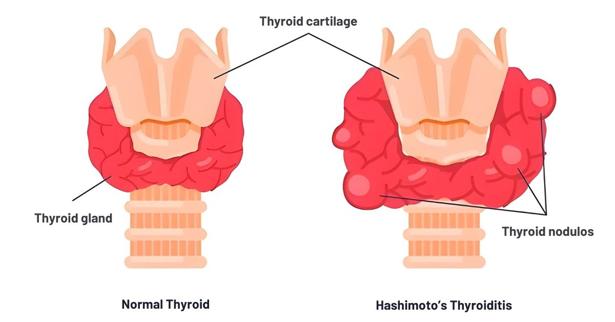 What is Hashimoto’s Thyroiditis?