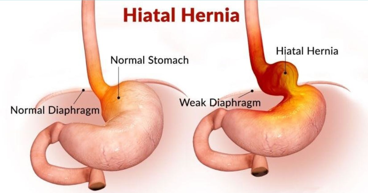 What Is Hiatus Hernia Surgery