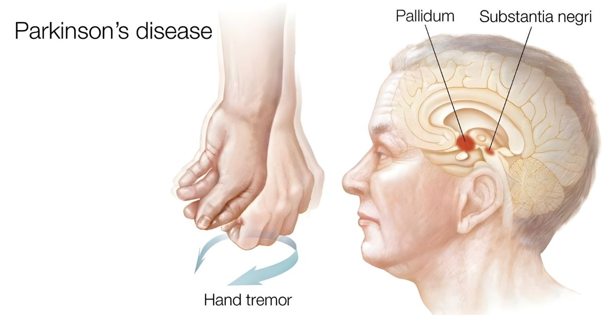 What is Parkinson’s Disease?