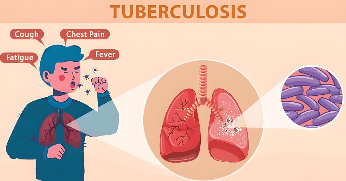 What is Tuberculosis?