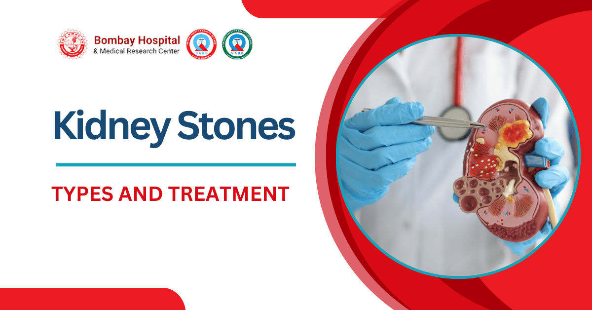Types of Kidney Stones and How They’re Treated