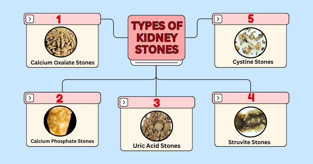Learn about Types of Kidney Stones in Mumbai at Bombay Hospital