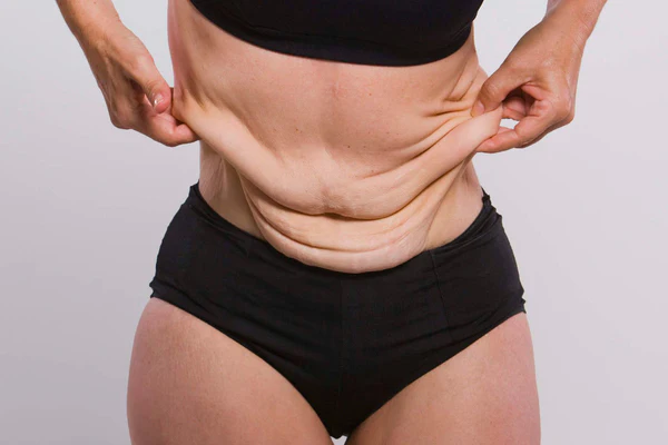 Body Contouring Surgeries for Loose Skin After Weight Loss Injections