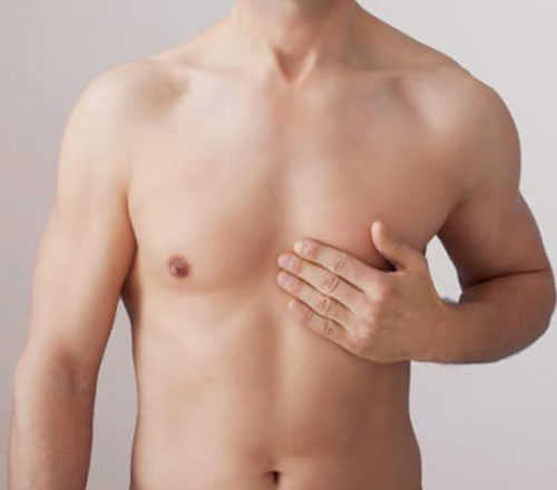 Occult (Scarless) Technique for Gynecomastia Surgery in Mumbai