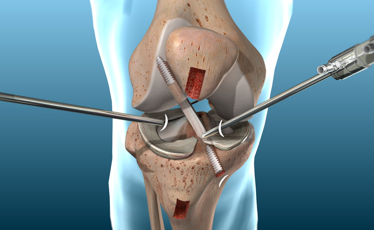 ACL Reconstruction Surgery - Dr. Ameya Katariya