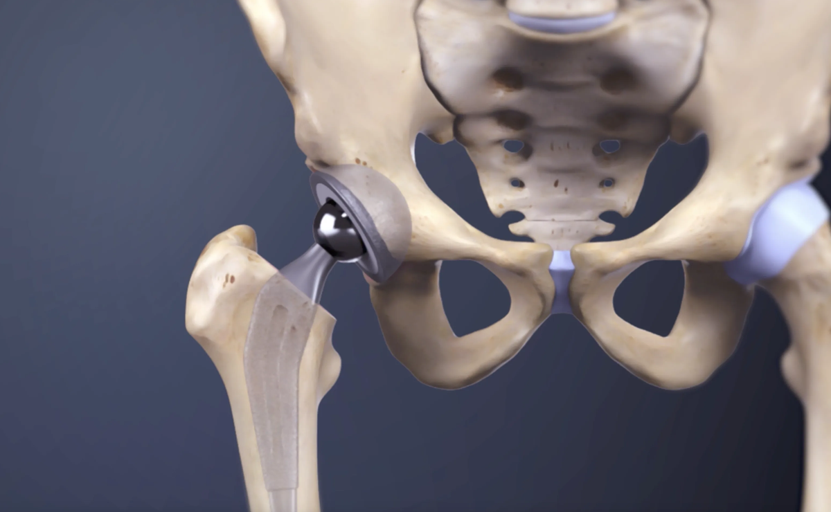 Anterior Hip Replacement Surgery - Dr. Ameya Katariya