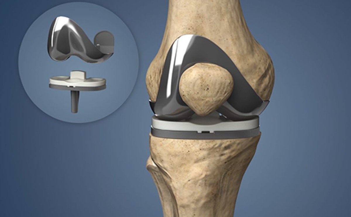 Total Knee Replacement Surgery by Dr. Ameya Katariya