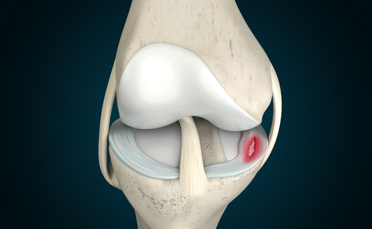 Meniscal Tears Treatment - Dr. Ameya Katariya