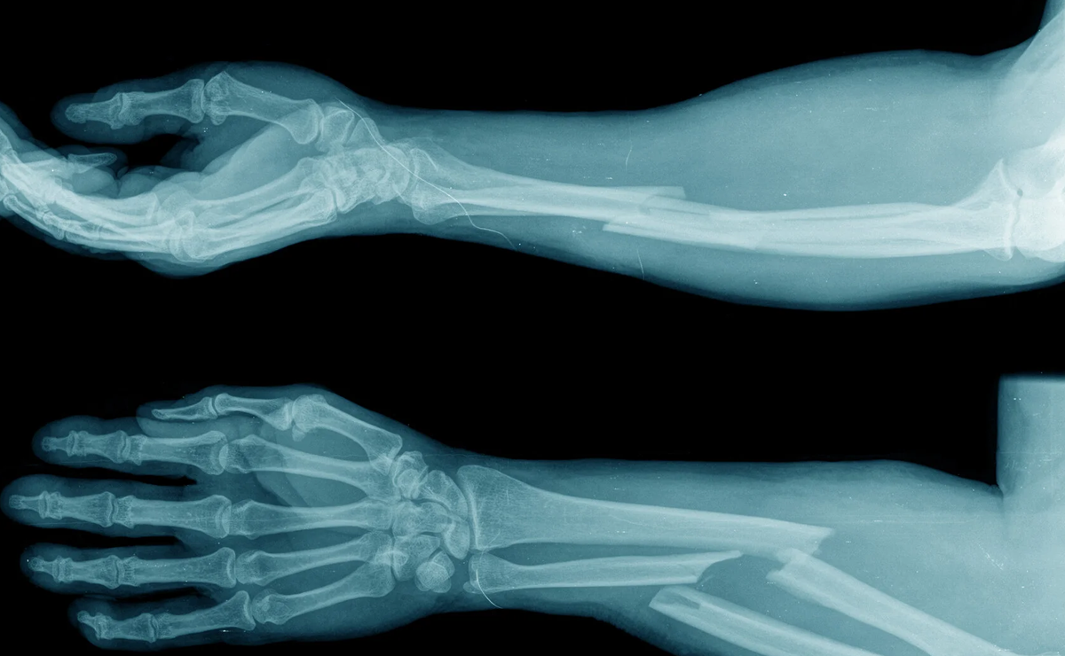 Orthopaedic Trauma and Fracture Care in Pune by Dr. Ameya Katariya