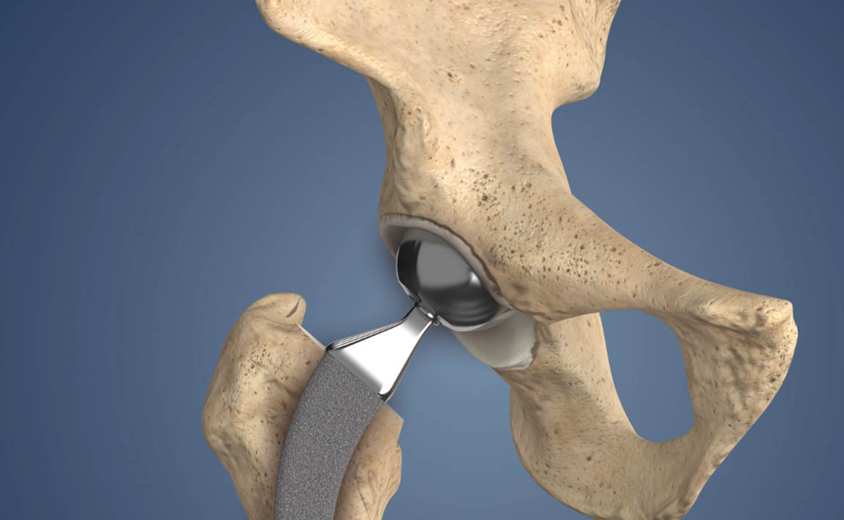 Partial Hip Replacement Surgery Expert in Pune