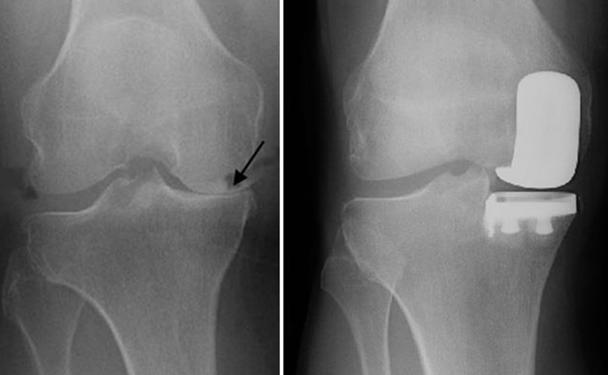 Partial Knee Replacement Surgery specialist - Dr. Ameya Katariya