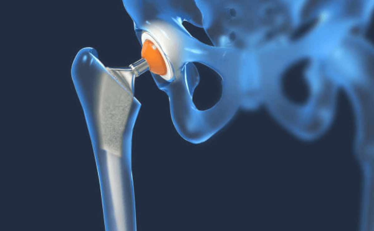 Revision Hip Replacement Surgery Expert in Pune
