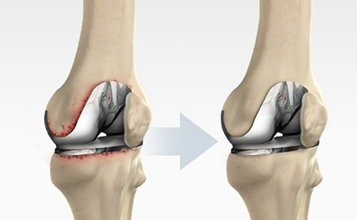 Revision Knee Replacement Surgery Pune - Dr. Ameya Katariya