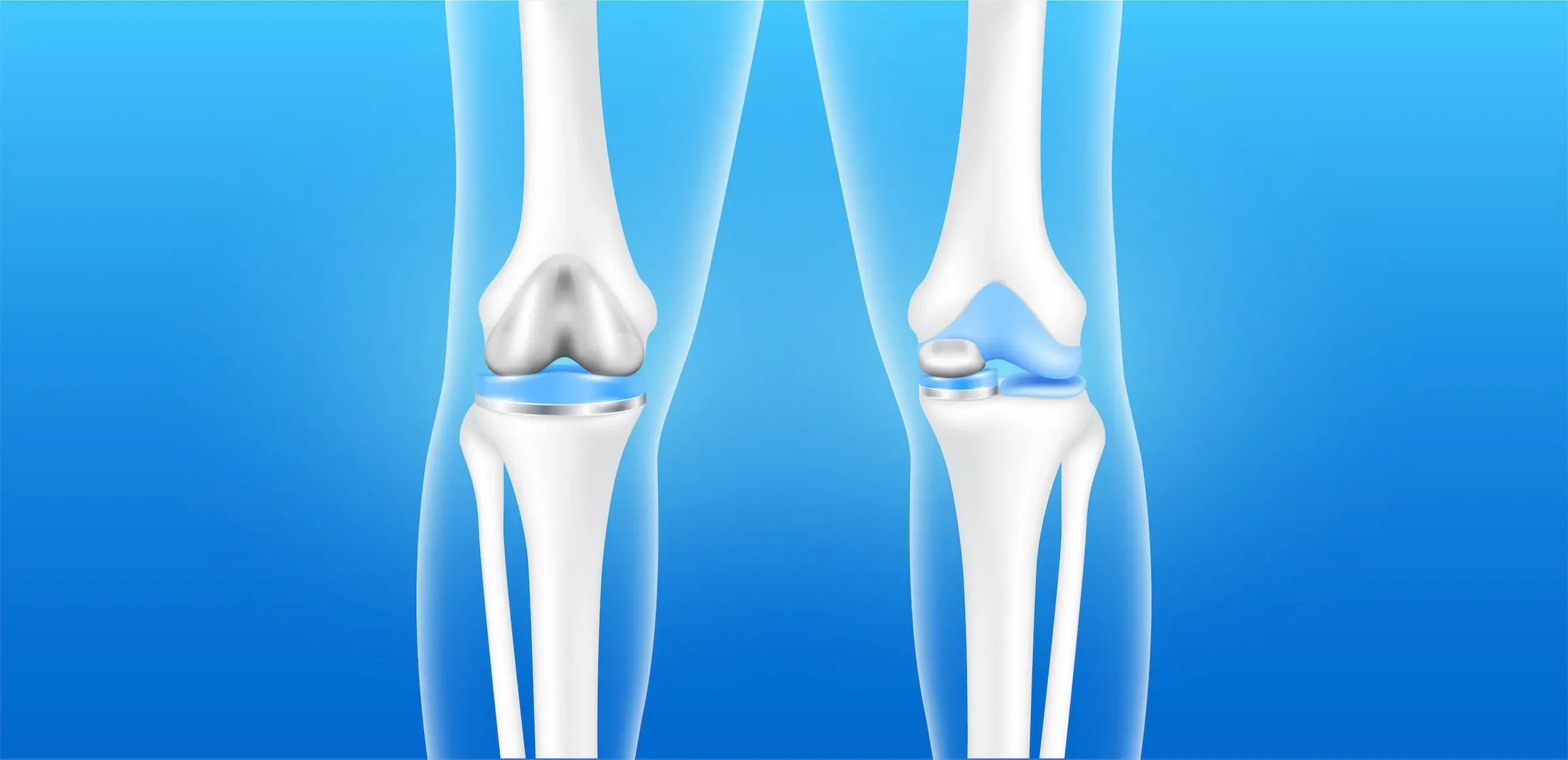 What is Partial Knee Replacement Surgery?