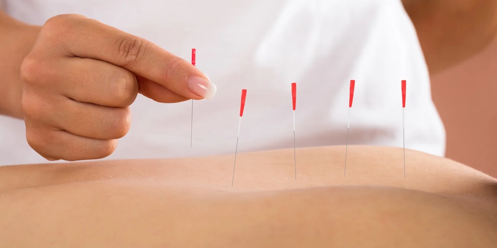 Dry Needling Therapy in Vashi | Physio Matters Clinic Navi Mumbai