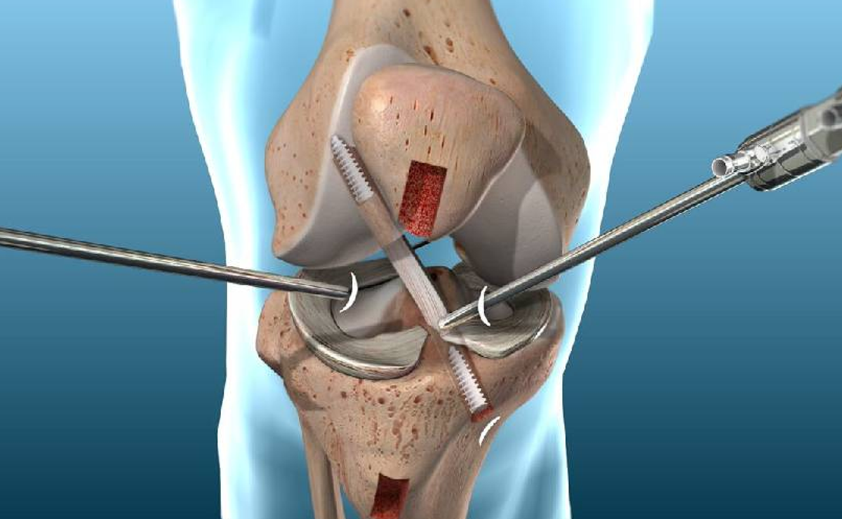 Arthroscopic Ligament Reconstruction for ACL/PCL Tears in Pune - Dr. Sahil Lombar