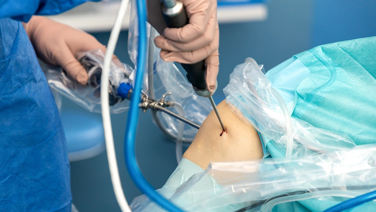 Benefits of Knee Arthroscopy