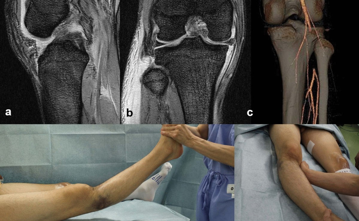 Complex Multiligament Injury Treatment and Reconstruction Surgery in Pune - Dr. Sahil Lombar