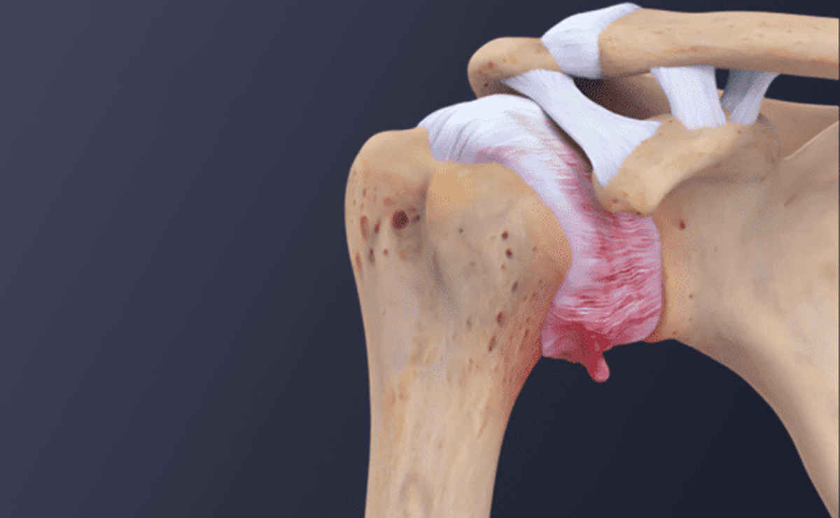 Frozen Shoulder Treatment and Therapy in Pune - Dr. Sahil Lombar