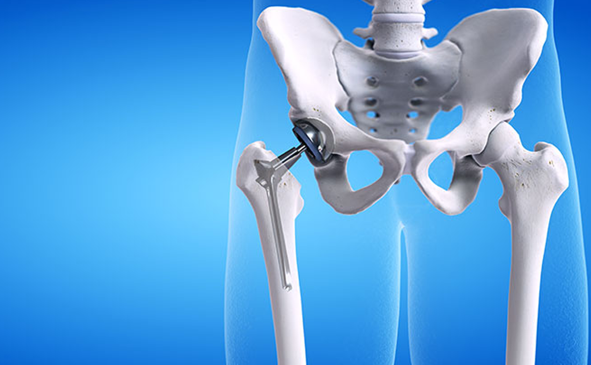 Expert Total Hip Replacement Surgery in Pune - Dr. Sahil Lombar
