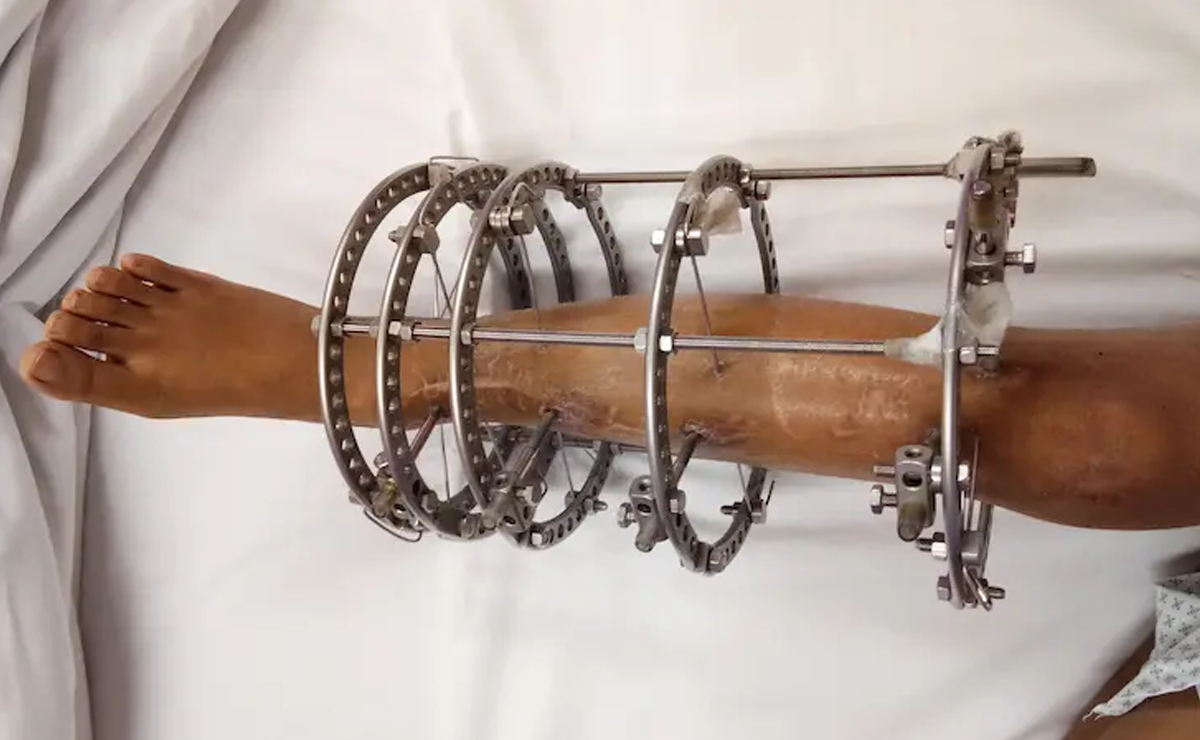 Ilizarov Limb Reconstruction Surgery and Deformity Correction in Pune - Dr. Sahil Lombar