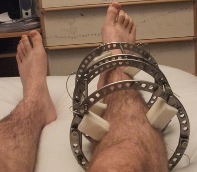 Ilizarov Reconstruction