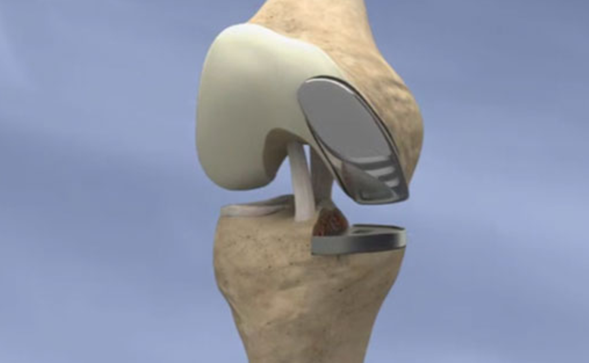 Knee Preservation Surgeries (HTO & DFO) in Pune - Dr. Sahil Lombar