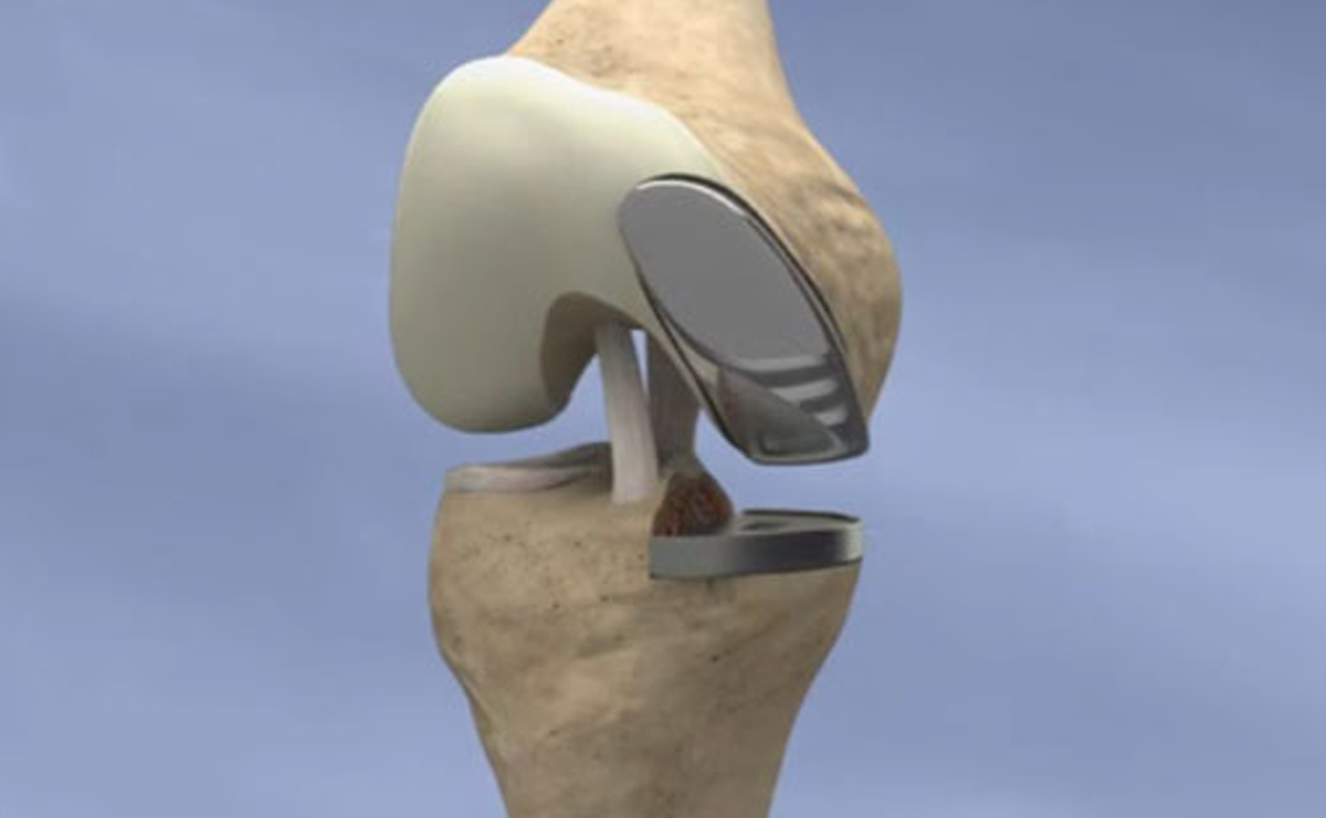 Partial Knee Replacement Surgery in Pune - Dr. Sahil Lombar