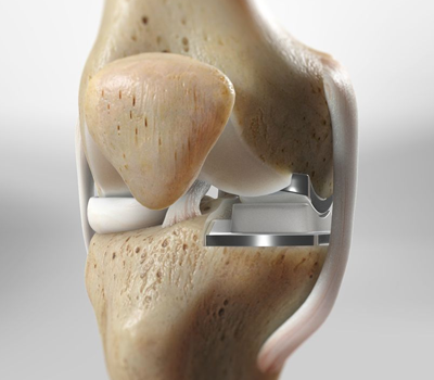 Partial Knee Replacement