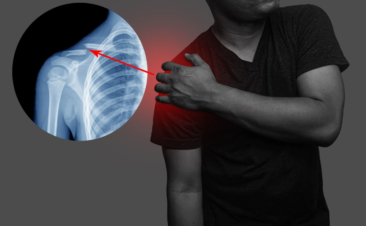 Recurrent Shoulder Dislocations Treatment in Pune - Dr. Sahil Lombar