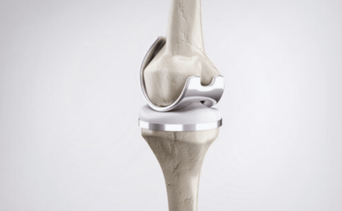 Total Knee Replacement Surgery in Pune - Dr. Sahil Lombar