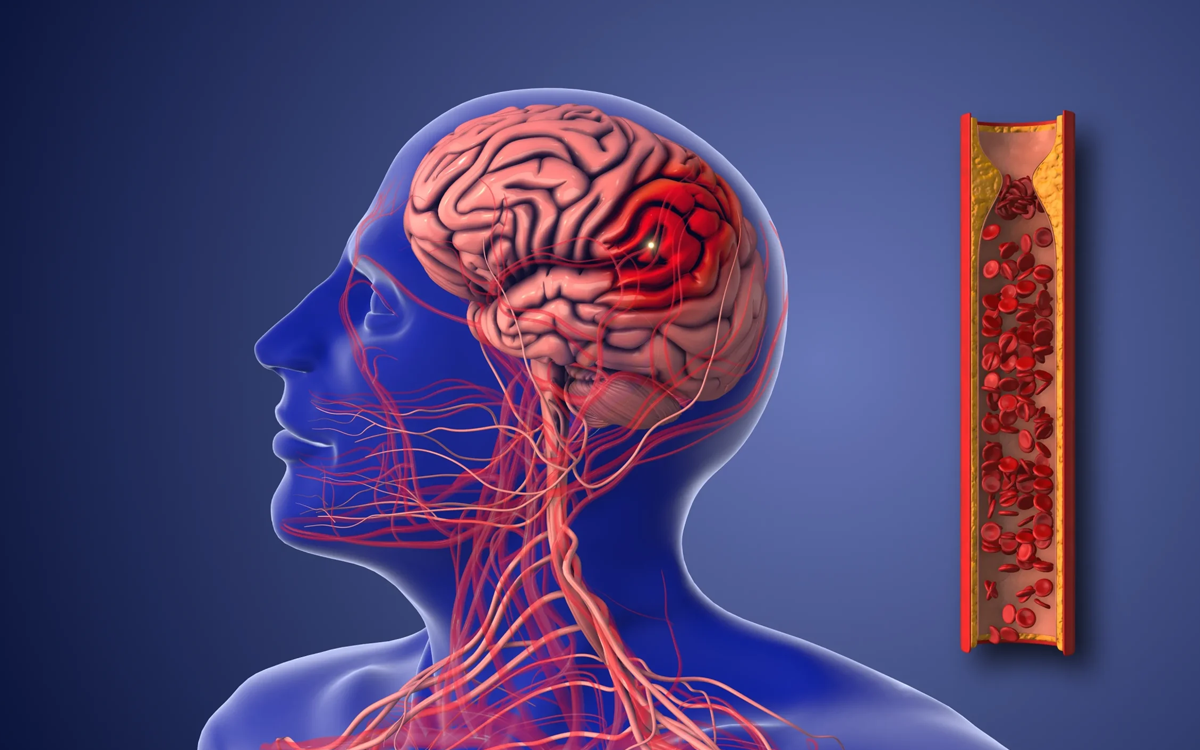 Brain Artery Health Care